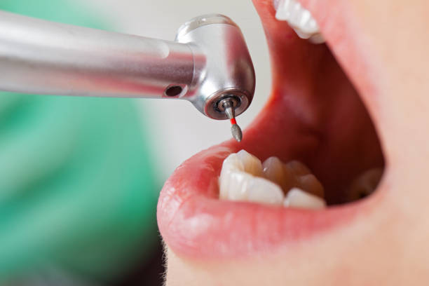 Best Emergency Wisdom Teeth Removal in Ellsworth, WI